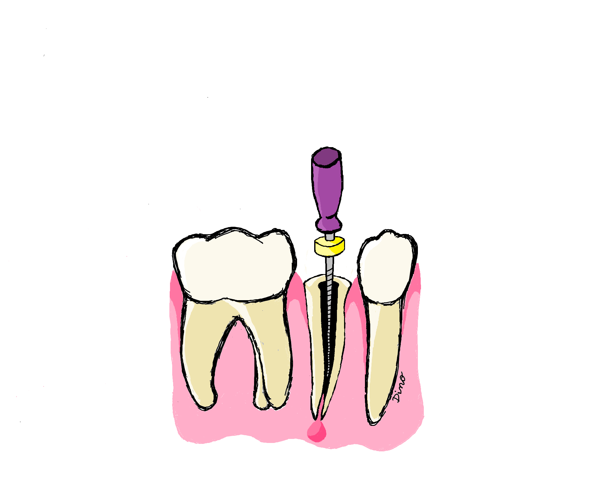 ROOT CANALS